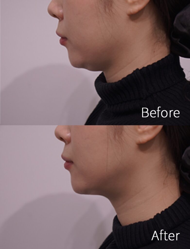 Double Chin Surgery in Korea
