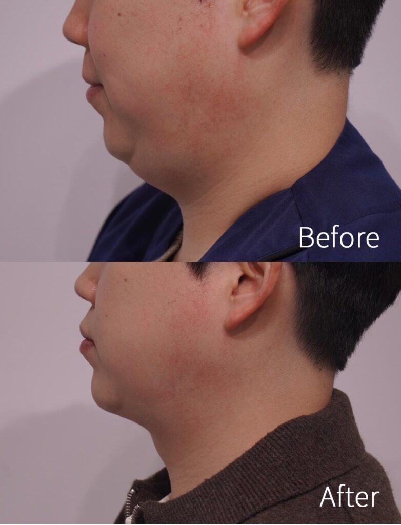 Double Chin Surgery in Korea