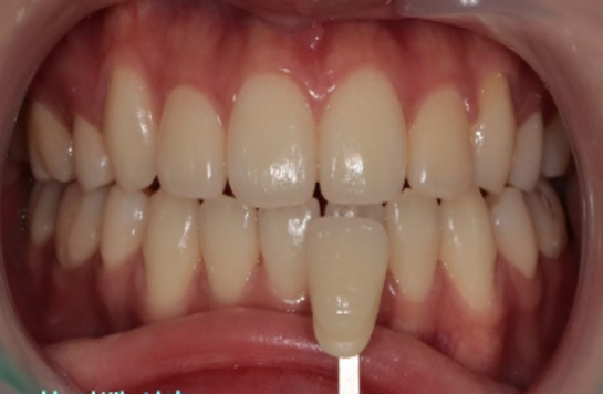 Teeth Whitening Busan