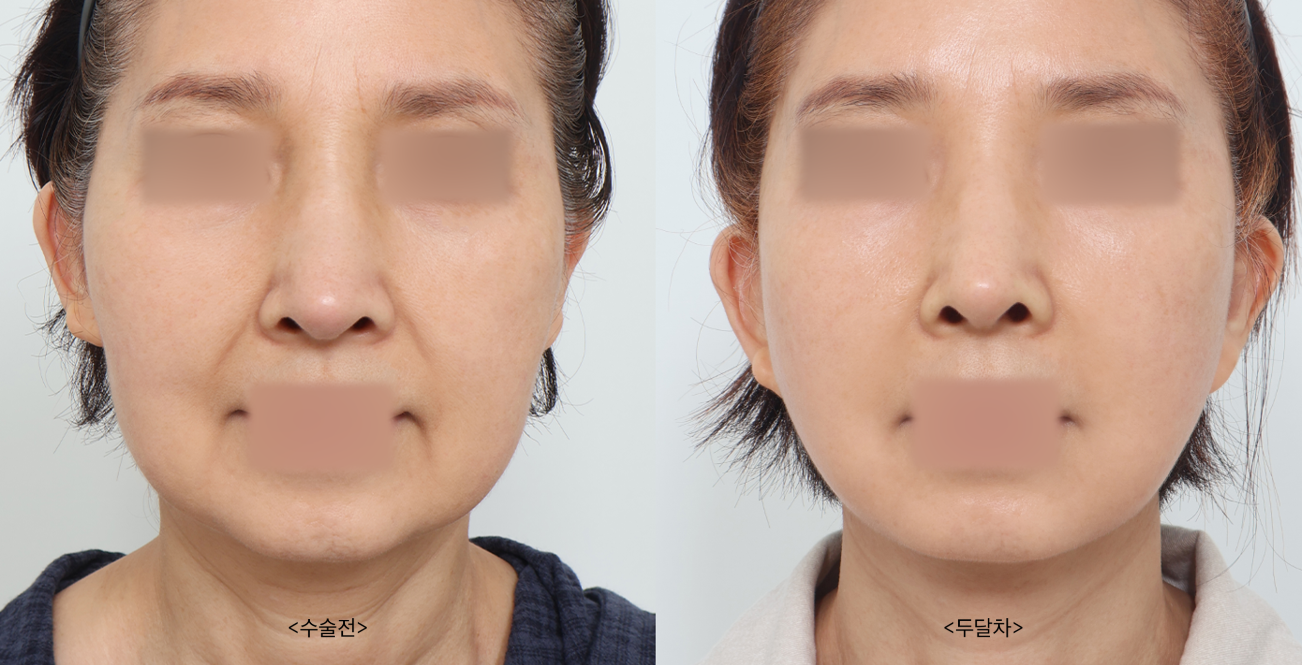 Face Lift Surgery in Busan