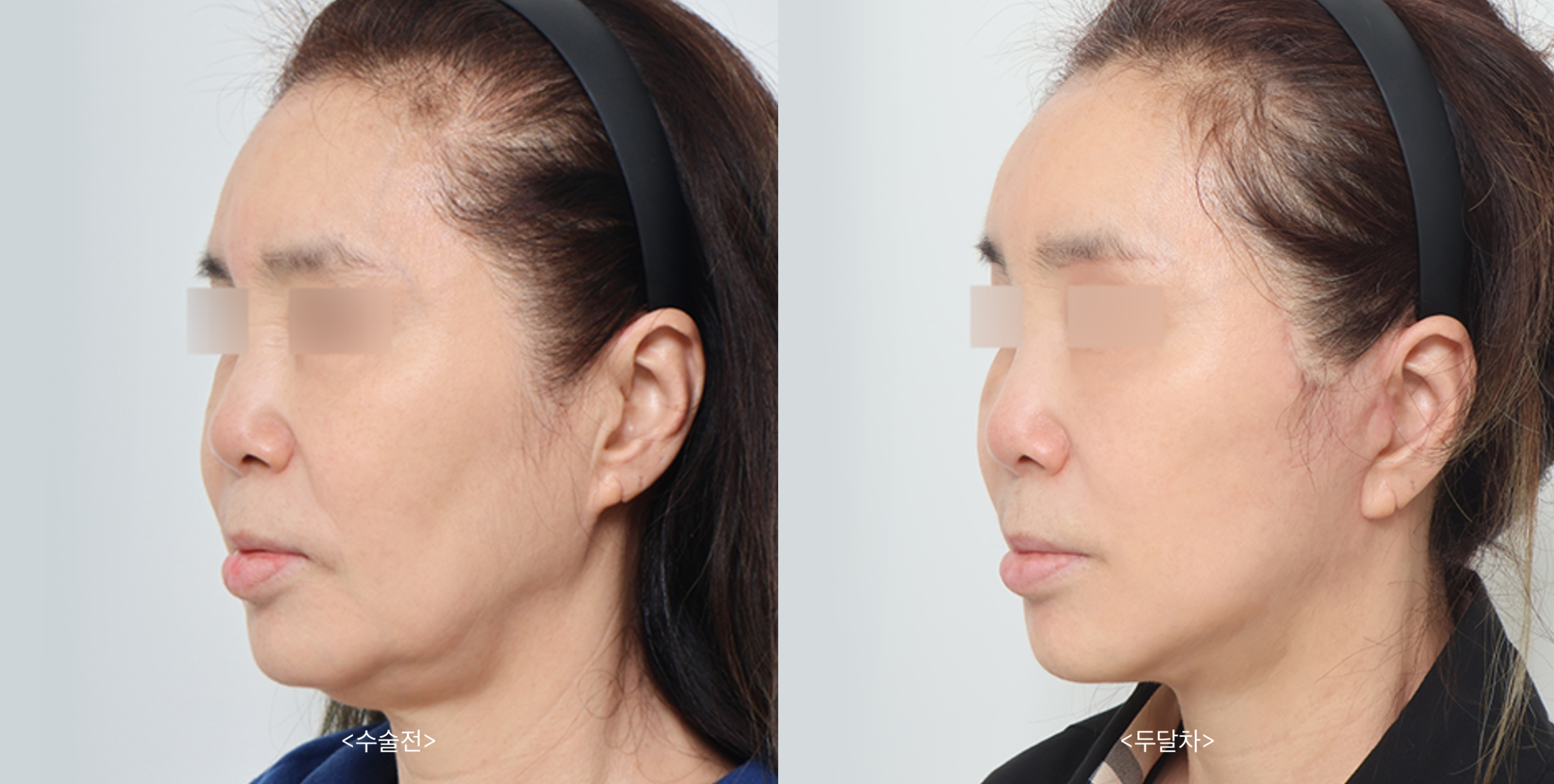 Face Lift Surgery in Busan