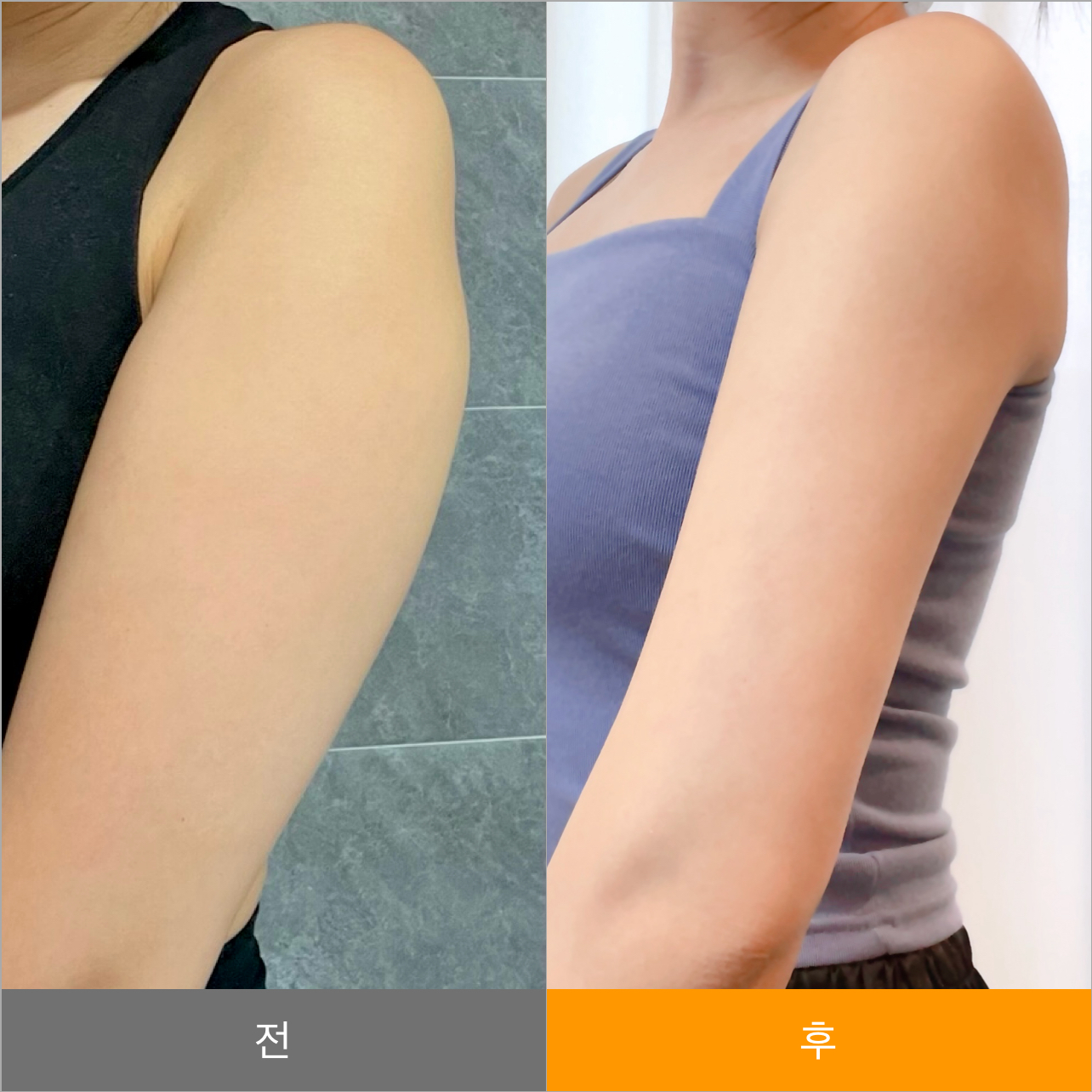 Body Contouring in Korea