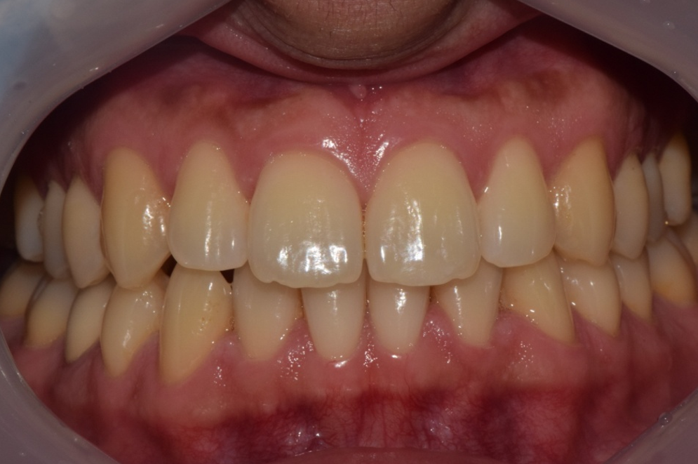 Teeth Whitening