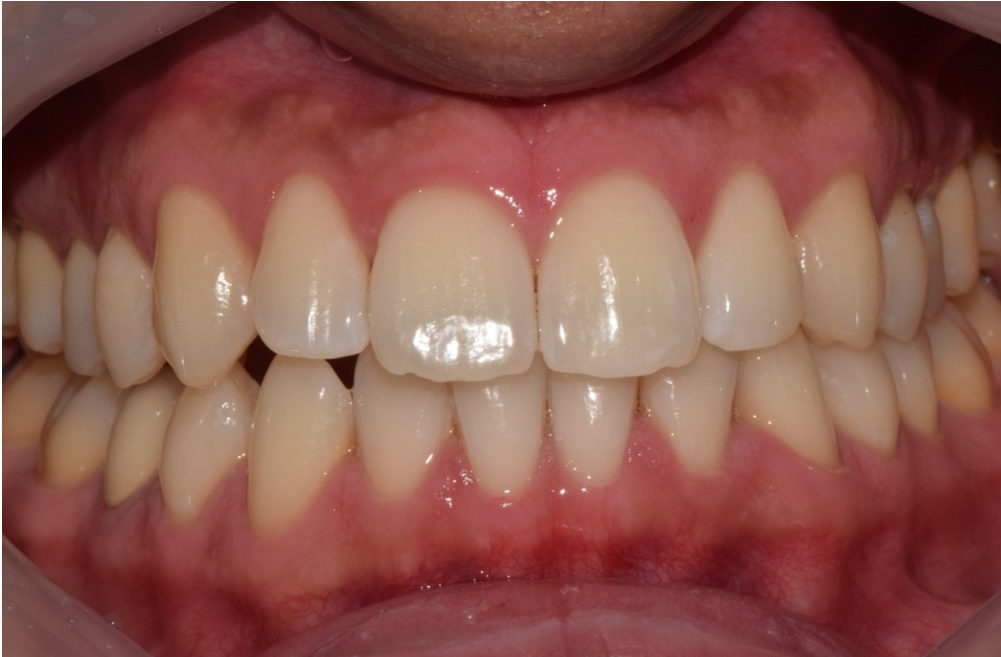 Teeth Whitening
