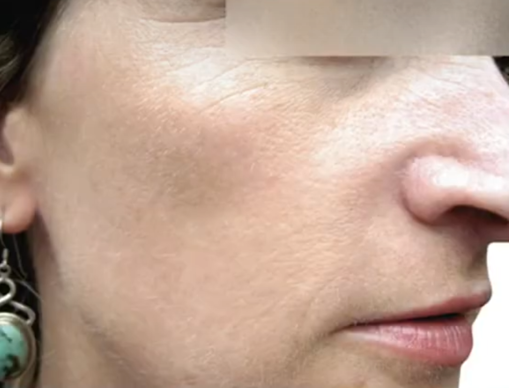 Pigmentation Treatment in Korea