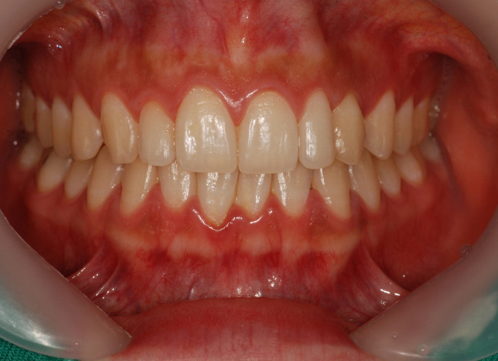 Teeth Whitening in Busan