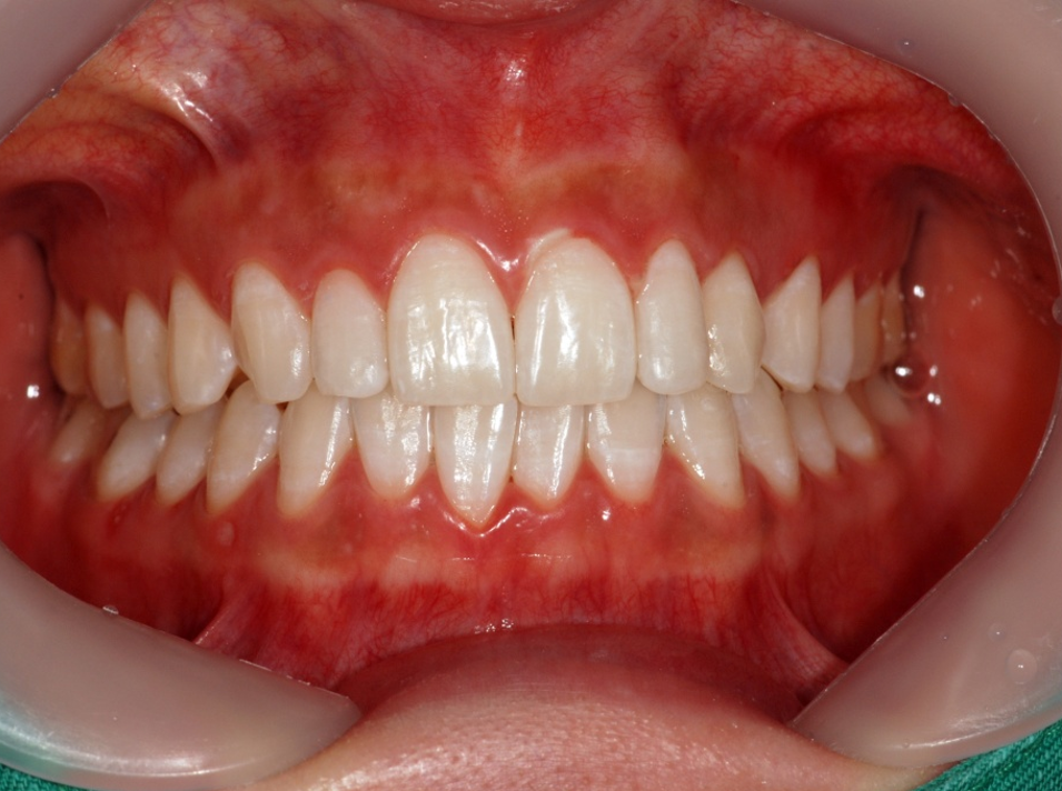 Teeth Whitening in Busan