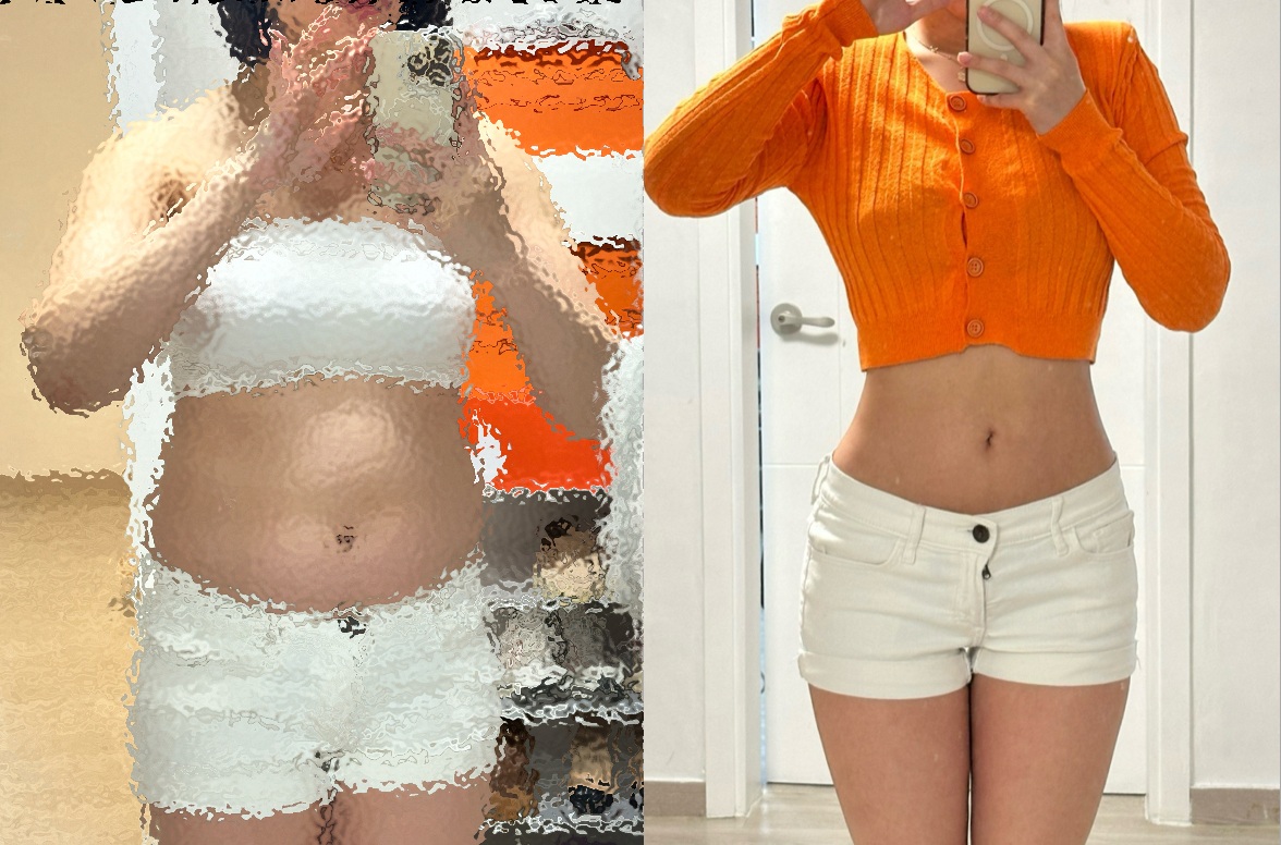 Liposuction in Korea