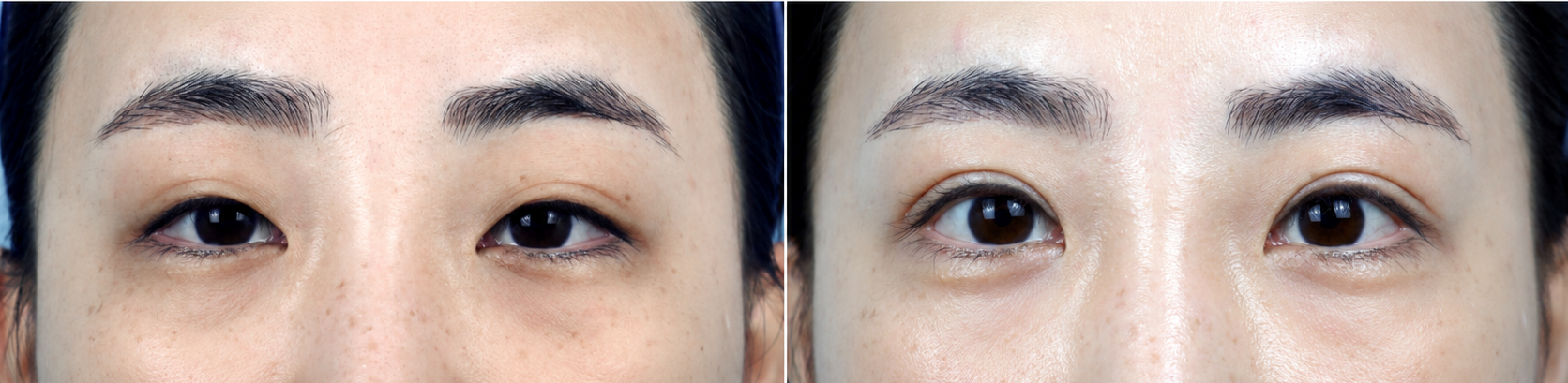 Droopy Eyelid Surgery in Korea
